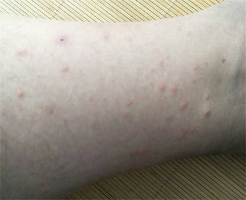 湿疹是不是不能喝白酒