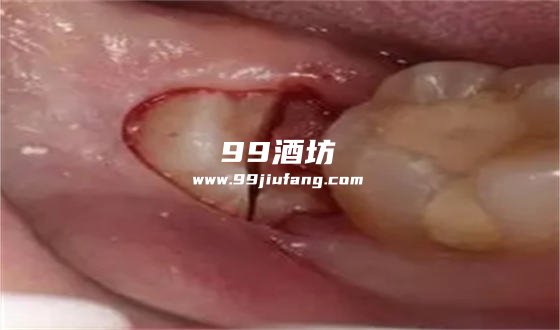 智齿牙周炎喝白酒行吗
