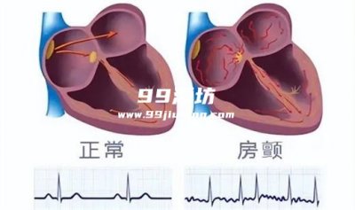 每天喝白酒房颤会严重吗