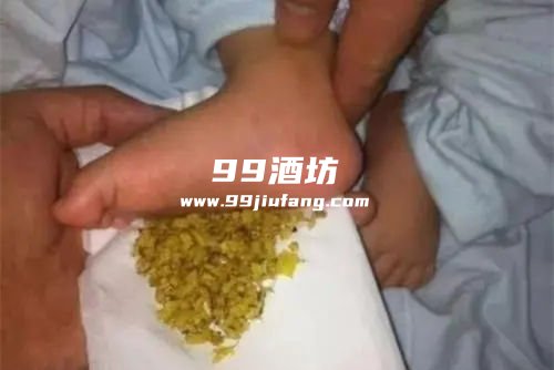 白酒泡生姜贴在脚心上