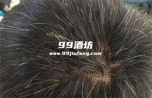 白酒泡鸡蛋治疗白发吗