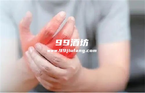 啤酒白酒哪个会引起痛风发作
