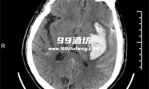 喝了白酒脑出血怎么回事