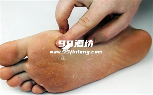 真菌感染能用白酒消毒吗