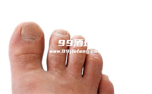 真菌感染能用白酒消毒吗