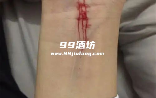 胳膊被猫抓出血能用白酒消毒吗