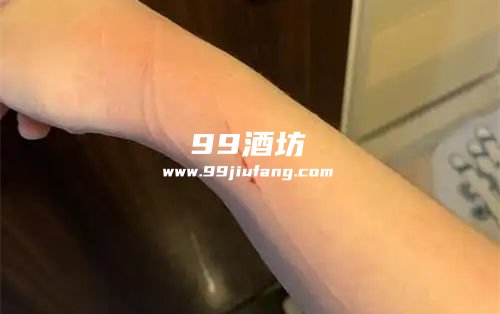 胳膊被猫抓出血能用白酒消毒吗