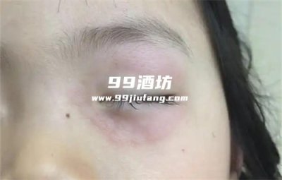 喝完白酒眼睛周围长红斑什么情况