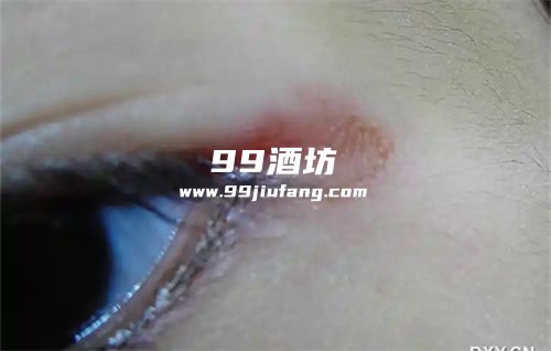 喝完白酒眼睛周围长红斑什么情况