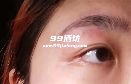喝完白酒眼睛周围长红斑什么情况