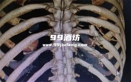 肋骨断裂还能喝白酒吗