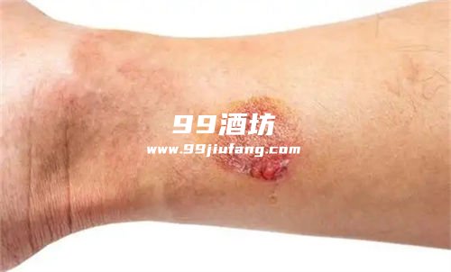 如何用白酒将烧伤皮肤恢复