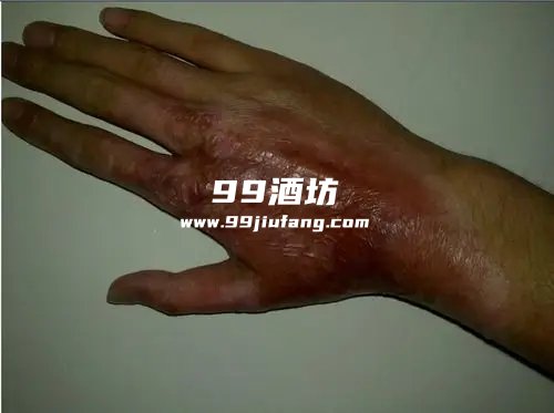 如何用白酒将烧伤皮肤恢复