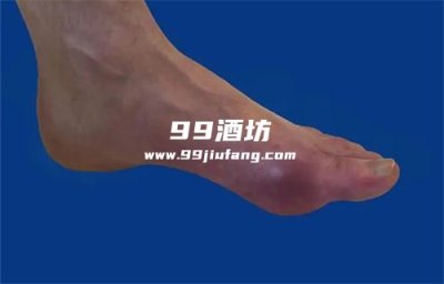 尿酸高喝白酒后关节疼痛是为啥？人久久为您解析
