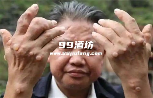 尿酸高喝白酒后关节疼痛是为啥？人久久为您解析