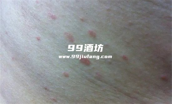喝多了白酒会影响皮肤吗