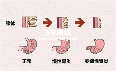 喝了白酒胃不舒服能吃胃药吗
