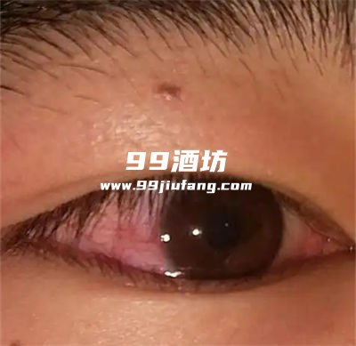 喝了白酒眼睛红不舒服咋回事