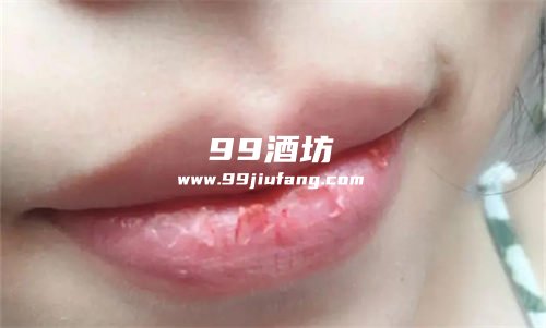 喝多了白酒会引起嘴唇干燥吗？人久久为您分析
