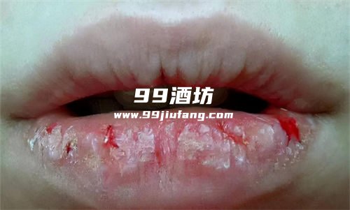 喝多了白酒会引起嘴唇干燥吗？人久久为您分析