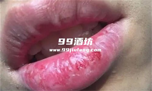 喝多了白酒会引起嘴唇干燥吗？人久久为您分析