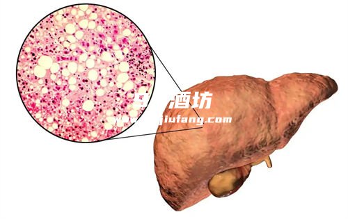 喝白酒可以缓解乳腺结节吗