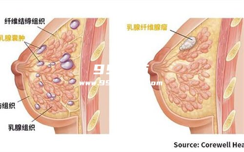 喝白酒可以缓解乳腺结节吗