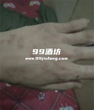 喝完白酒怎么会全身发红呢